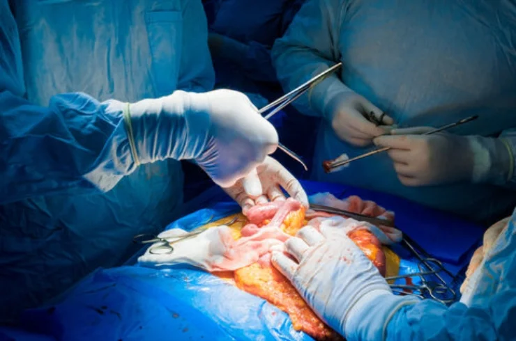 Gastrointestinal Cancer Surgeries------11